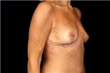 Breast Implant Removal After Photo by Landon Pryor, MD, FACS; Rockford, IL - Case 47709