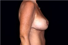 Breast Implant Removal Before Photo by Landon Pryor, MD, FACS; Rockford, IL - Case 47709