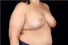 Breast Implant Removal After Photo by Landon Pryor, MD, FACS; Rockford, IL - Case 47710