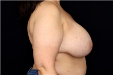 Breast Implant Removal Before Photo by Landon Pryor, MD, FACS; Rockford, IL - Case 47710
