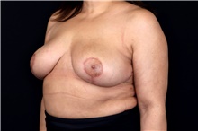 Breast Implant Removal After Photo by Landon Pryor, MD, FACS; Rockford, IL - Case 47711