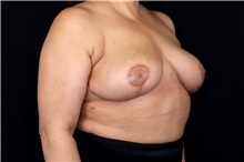 Breast Implant Removal After Photo by Landon Pryor, MD, FACS; Rockford, IL - Case 47711