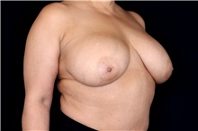 Breast Implant Removal Before Photo by Landon Pryor, MD, FACS; Rockford, IL - Case 47711