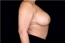 Breast Implant Removal Before Photo by Landon Pryor, MD, FACS; Rockford, IL - Case 47711