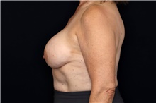 Breast Implant Removal Before Photo by Landon Pryor, MD, FACS; Rockford, IL - Case 47714