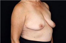 Breast Implant Removal After Photo by Landon Pryor, MD, FACS; Rockford, IL - Case 47714