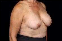 Breast Implant Removal Before Photo by Landon Pryor, MD, FACS; Rockford, IL - Case 47714