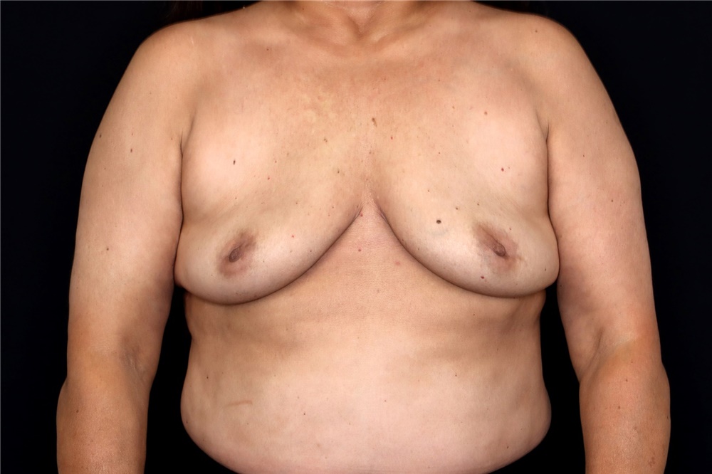 Breast Implant Removal Before and After Photos by Landon Pryor, MD, FACS;  Rockford, IL - Case 47715