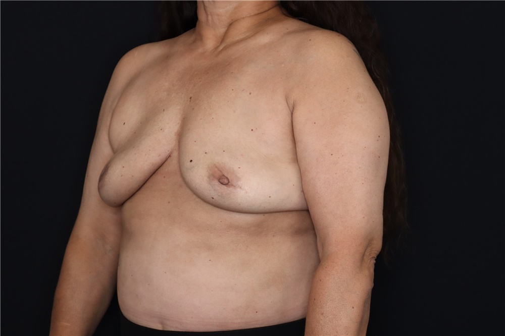 Breast Implant Removal Before and After Photos by Landon Pryor, MD, FACS;  Rockford, IL - Case 47715