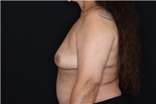 Breast Implant Removal After Photo by Landon Pryor, MD, FACS; Rockford, IL - Case 47715