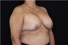 Breast Implant Removal Before Photo by Landon Pryor, MD, FACS; Rockford, IL - Case 47715