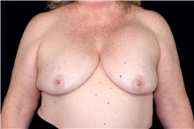 Breast Implant Removal Before Photo by Landon Pryor, MD, FACS; Rockford, IL - Case 47716