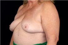 Breast Implant Removal After Photo by Landon Pryor, MD, FACS; Rockford, IL - Case 47716
