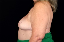 Breast Implant Removal After Photo by Landon Pryor, MD, FACS; Rockford, IL - Case 47716