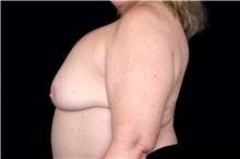 Breast Implant Removal Before Photo by Landon Pryor, MD, FACS; Rockford, IL - Case 47716