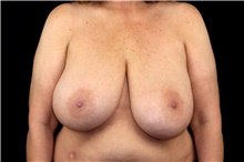 Breast Implant Removal Before Photo by Landon Pryor, MD, FACS; Rockford, IL - Case 47717