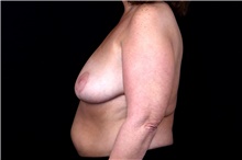 Breast Implant Removal After Photo by Landon Pryor, MD, FACS; Rockford, IL - Case 47717