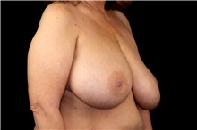 Breast Implant Removal Before Photo by Landon Pryor, MD, FACS; Rockford, IL - Case 47717
