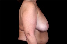 Breast Implant Removal After Photo by Landon Pryor, MD, FACS; Rockford, IL - Case 47717