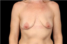 Breast Implant Removal After Photo by Landon Pryor, MD, FACS; Rockford, IL - Case 47719