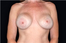 Breast Implant Removal Before Photo by Landon Pryor, MD, FACS; Rockford, IL - Case 47719