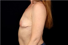 Breast Implant Removal After Photo by Landon Pryor, MD, FACS; Rockford, IL - Case 47719