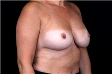 Breast Implant Removal Before Photo by Landon Pryor, MD, FACS; Rockford, IL - Case 47720