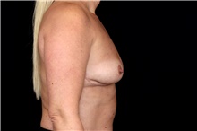 Breast Implant Removal After Photo by Landon Pryor, MD, FACS; Rockford, IL - Case 47720