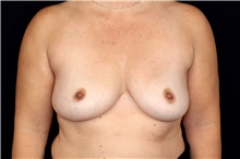 Breast Implant Removal After Photo by Landon Pryor, MD, FACS; Rockford, IL - Case 47721