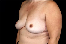 Breast Implant Removal After Photo by Landon Pryor, MD, FACS; Rockford, IL - Case 47721
