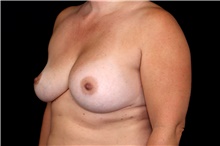 Breast Implant Removal Before Photo by Landon Pryor, MD, FACS; Rockford, IL - Case 47721