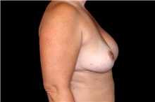 Breast Implant Removal Before Photo by Landon Pryor, MD, FACS; Rockford, IL - Case 47721