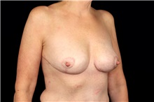 Breast Implant Removal After Photo by Landon Pryor, MD, FACS; Rockford, IL - Case 47724