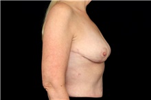 Breast Implant Removal After Photo by Landon Pryor, MD, FACS; Rockford, IL - Case 47724