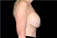 Breast Implant Removal Before Photo by Landon Pryor, MD, FACS; Rockford, IL - Case 47724