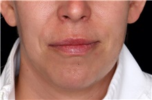 Lip Augmentation/Enhancement After Photo by Landon Pryor, MD, FACS; Rockford, IL - Case 47725
