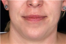 Lip Augmentation/Enhancement Before Photo by Landon Pryor, MD, FACS; Rockford, IL - Case 47725