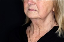 Injectable Fillers After Photo by Landon Pryor, MD, FACS; Rockford, IL - Case 47726