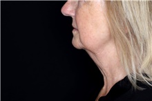 Injectable Fillers After Photo by Landon Pryor, MD, FACS; Rockford, IL - Case 47726
