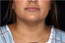 Liposuction After Photo by Landon Pryor, MD, FACS; Rockford, IL - Case 47728