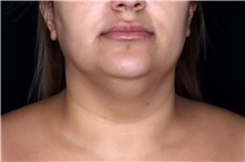 Liposuction Before Photo by Landon Pryor, MD, FACS; Rockford, IL - Case 47728