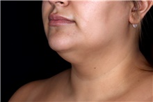 Liposuction Before Photo by Landon Pryor, MD, FACS; Rockford, IL - Case 47728
