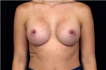 Breast Augmentation After Photo by Landon Pryor, MD, FACS; Rockford, IL - Case 47735