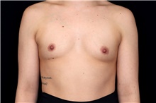Breast Augmentation Before Photo by Landon Pryor, MD, FACS; Rockford, IL - Case 47735