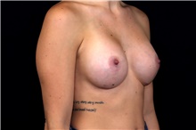 Breast Augmentation After Photo by Landon Pryor, MD, FACS; Rockford, IL - Case 47735
