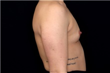 Breast Augmentation Before Photo by Landon Pryor, MD, FACS; Rockford, IL - Case 47735