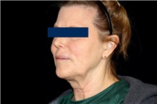 Facelift Before Photo by Landon Pryor, MD, FACS; Rockford, IL - Case 47737