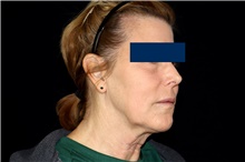 Facelift Before Photo by Landon Pryor, MD, FACS; Rockford, IL - Case 47737