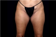 Thigh Lift Before and After Photos  American Society of Plastic Surgeons