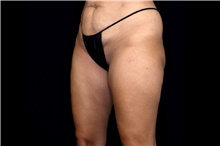 Thigh Lift Before Photo by Landon Pryor, MD, FACS; Rockford, IL - Case 47739